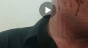 Foto bukti luka korban dalam kasus pengeroyokan di Kuantan Singingi